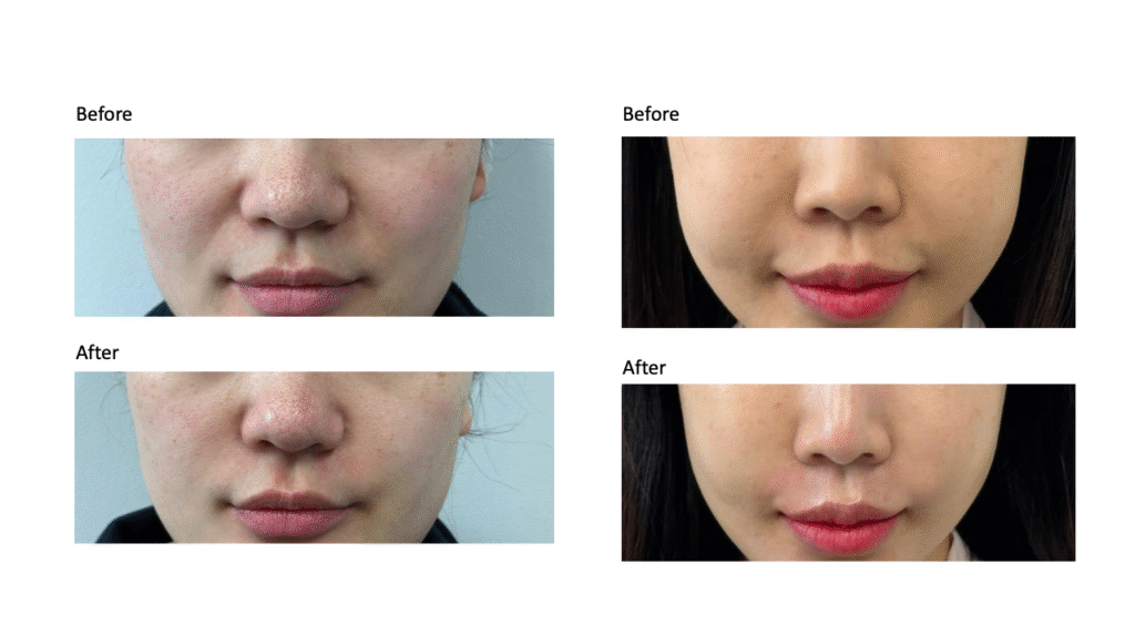 皇后電波全面解析：緊緻、拉提、修飾線條的多重應用